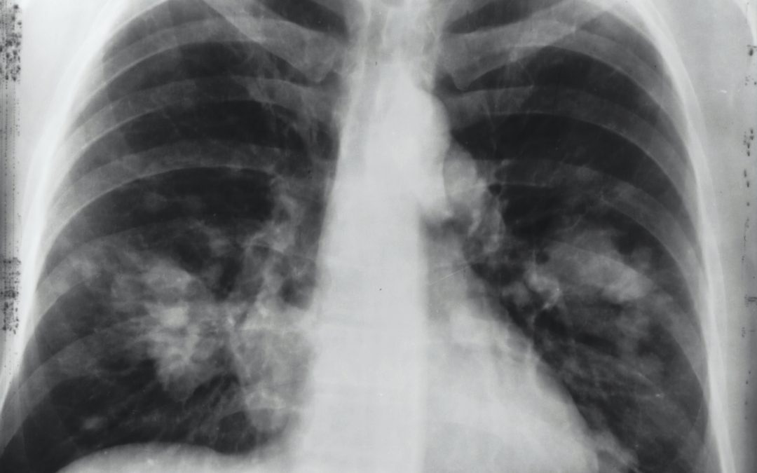 Study protocol for VIdeo assisted thoracoscopic lobectomy versus conventional Open LobEcTomy for lung cancer