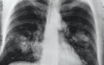 Study protocol for VIdeo assisted thoracoscopic lobectomy versus conventional Open LobEcTomy for lung cancer