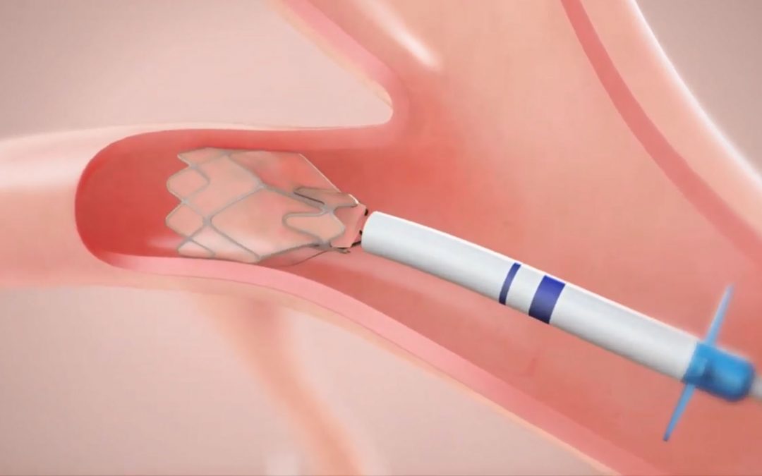 A Multicenter Randomized Controlled Trial of Zephyr Endobronchial Valve Treatment in Heterogeneous Emphysema